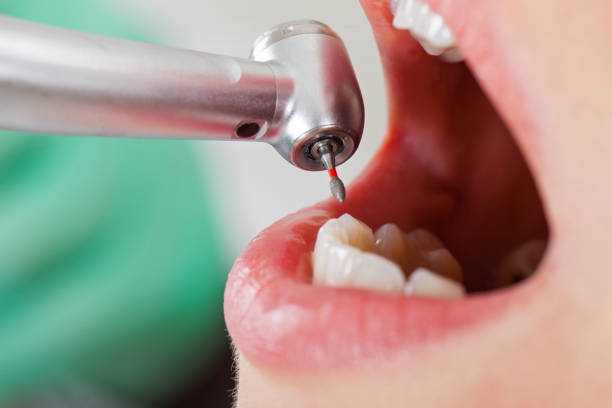 Best Emergency Wisdom Tooth Extraction in Seminole, FL
